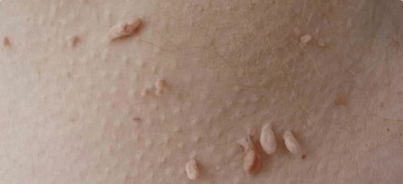 Transmission method from HPV