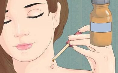 How to get rid of papillome folk remedies