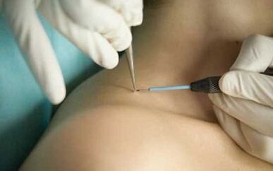 Papilloma distance methods