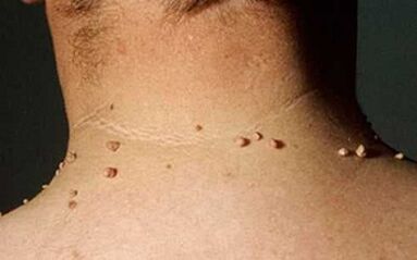 The reasons for the appearance of papillomas
