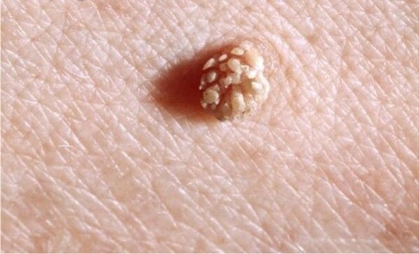 Papilloma