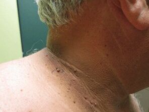 The reasons for the appearance of plural papillomas on the body