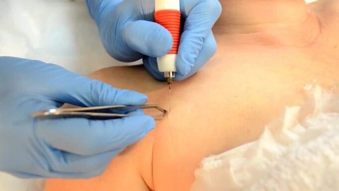 Electrocoagulation – a method of removing papillomas