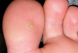 How to get rid of a plantar wart