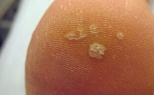Why do plantar warts occur