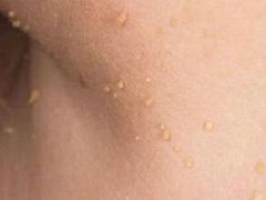 Reasons for the appearance of papillomas on the body