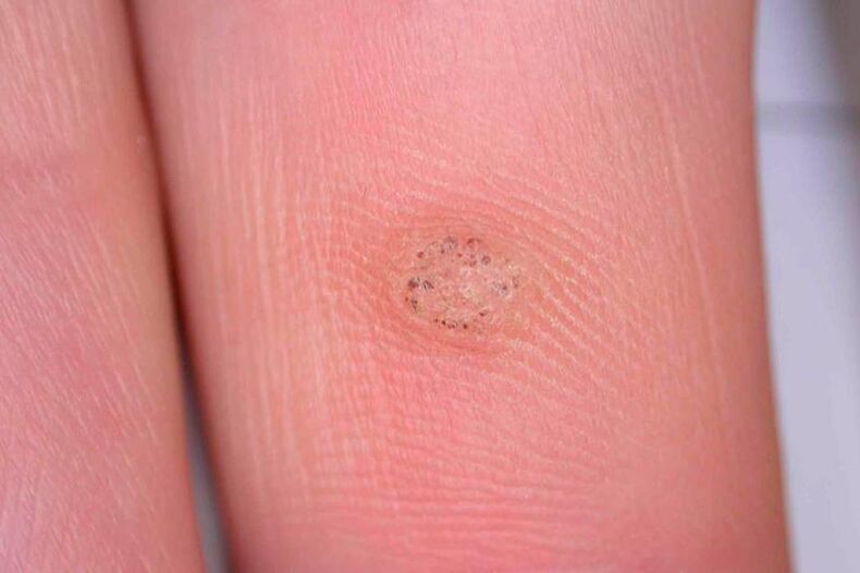 What are warts