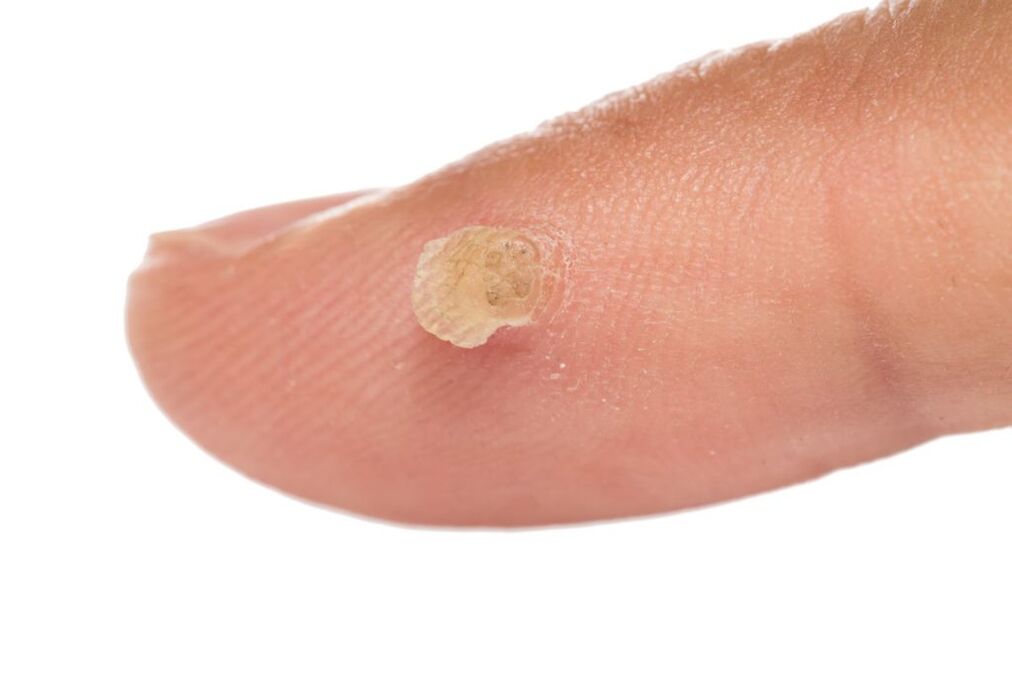 Genital wart on finger
