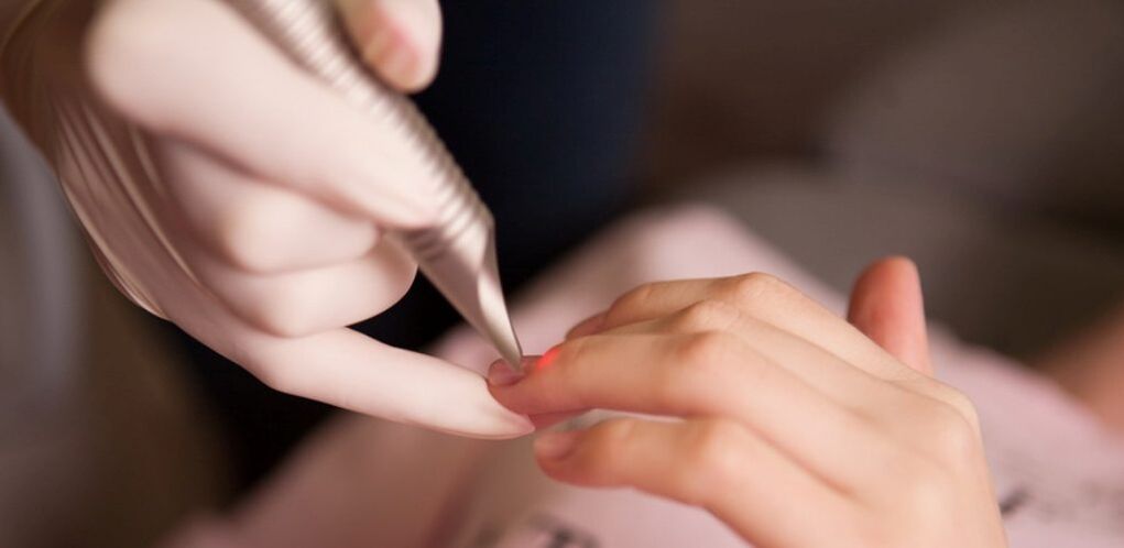 Laser treatment of warts