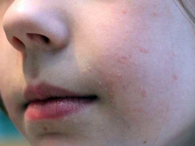 Flat warts on the face most often appear in adolescence
