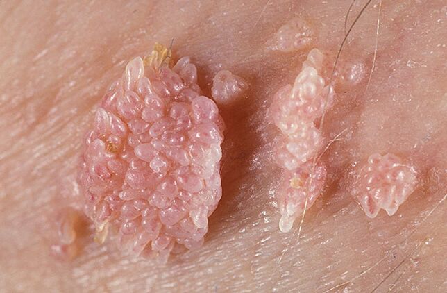 Papilloma is a benign, tumor-like formation of the skin and mucous membranes of a warty nature