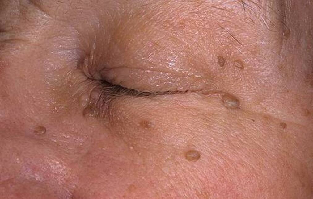 Papillomas on the skin of the face