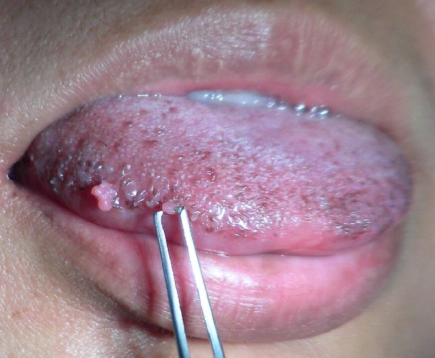 Papillomas on the tongue